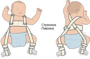 Stirrups Pavlik Velcro,all sizes,from the manufacturer 